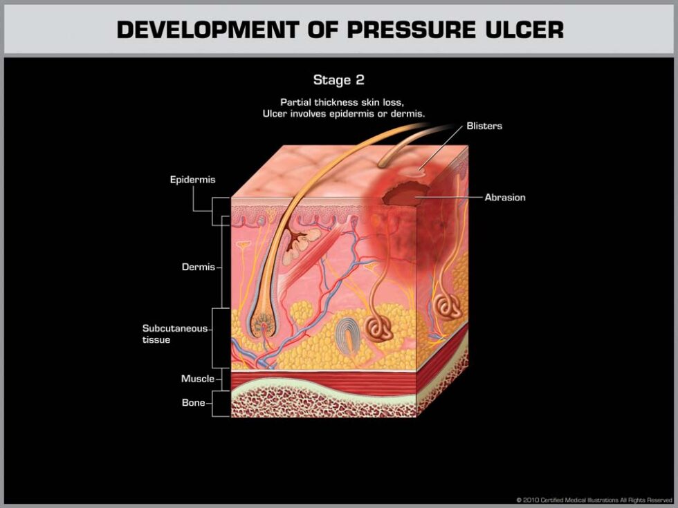 New Jersey Nursing Home Attorney Bedsores And Ulcer Injury Cherry Hill