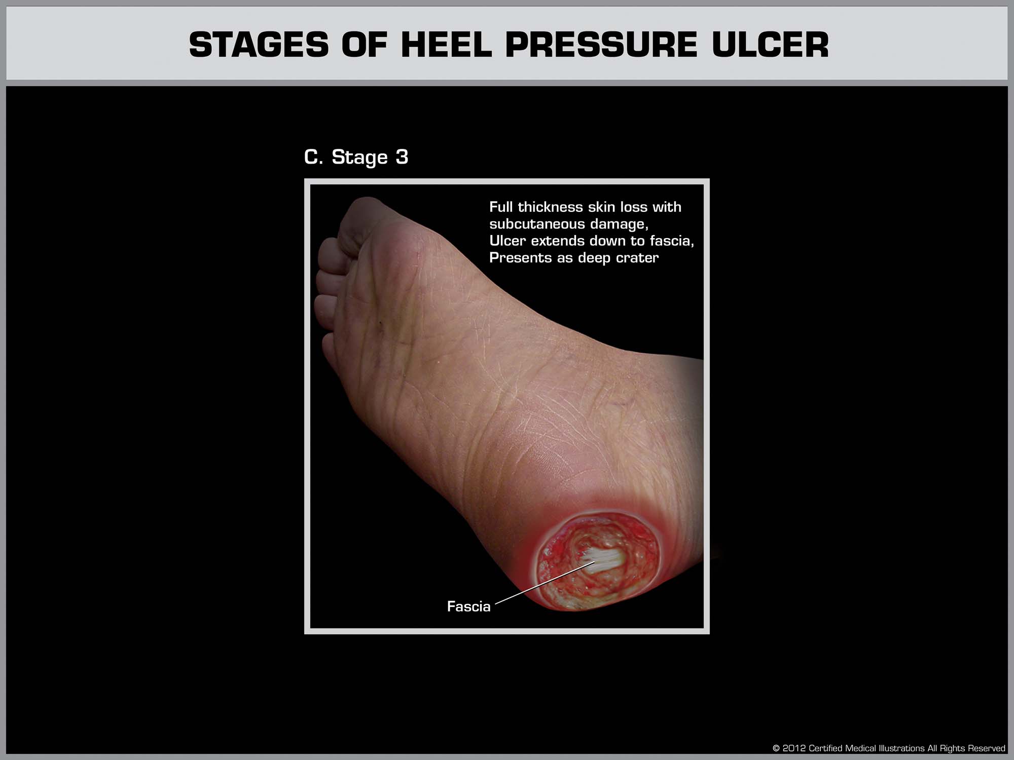 Pressure Ulcers Stage 3